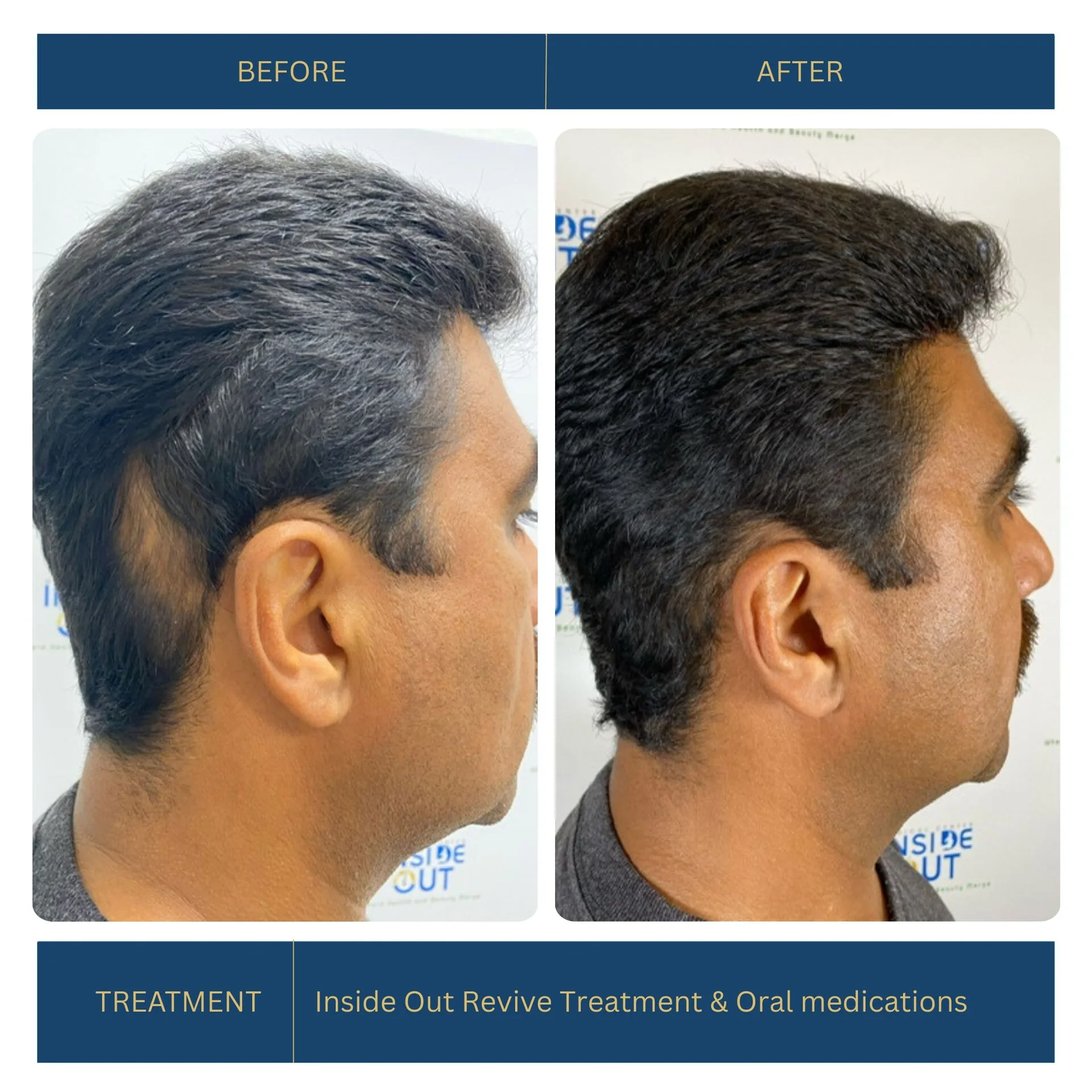 Before and after FUE hair transplant