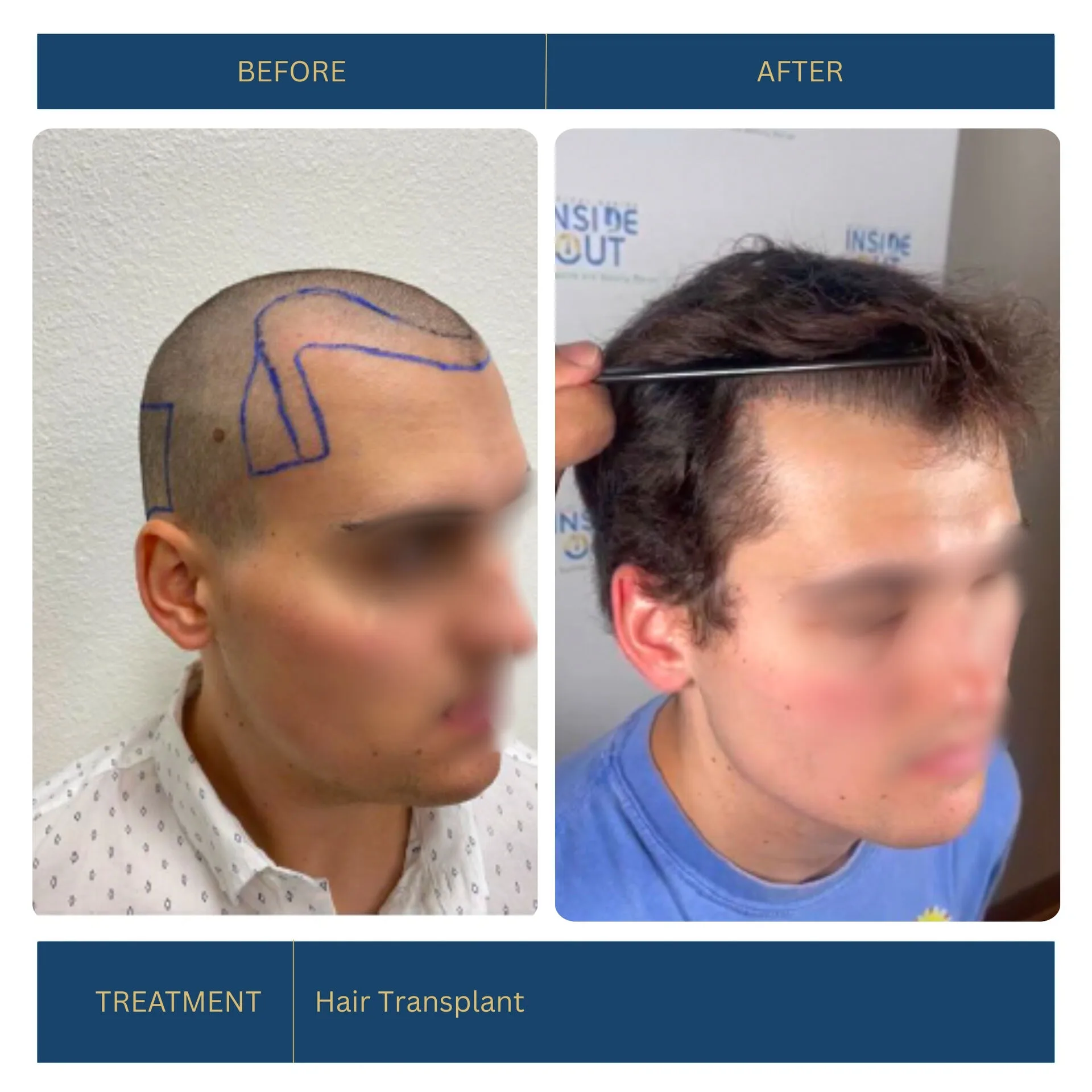 Before and after FUE hair transplant
