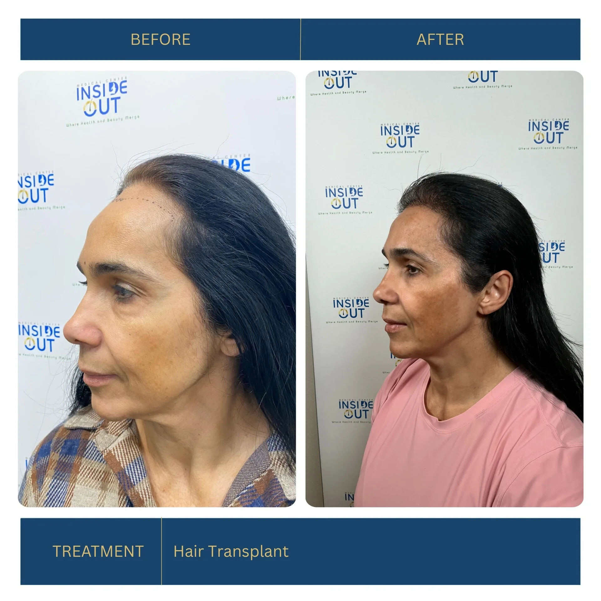 FUE Hair Transplant — Hairline & temples — patient at Inside Out Medical Center, Fresno